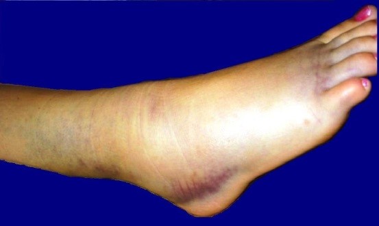 ankle-injury2