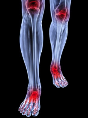 Rheumatoid Arthritis: Symptoms &amp; Causes